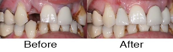 Dentexcel_Dental_Implant1.jpg