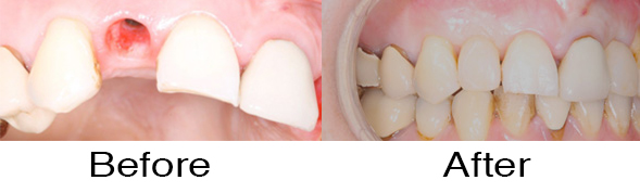 Dentexcel_Dental_Implant2.jpg