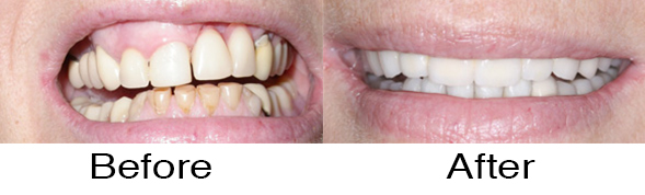 Dentexcel_Dental_Implant3.jpg