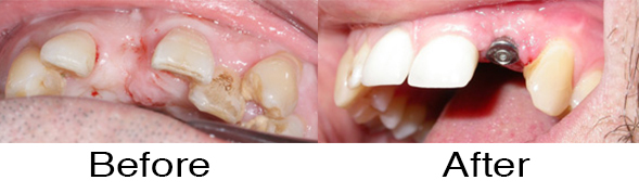 Dentexcel_Dental_Implant4.jpg