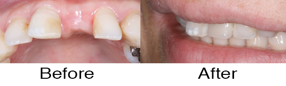 Dentexcel_Dental_Implant5.jpg