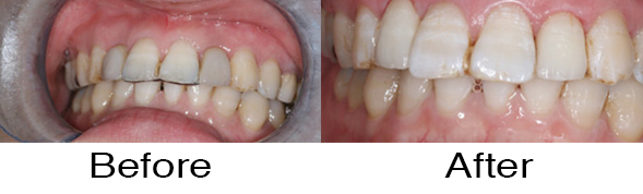 Dentexcel_Dental_Implant6.jpg