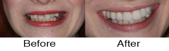 Dentexcel_Veneers4.jpg