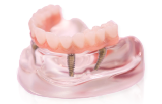 Dentexcel dental implant