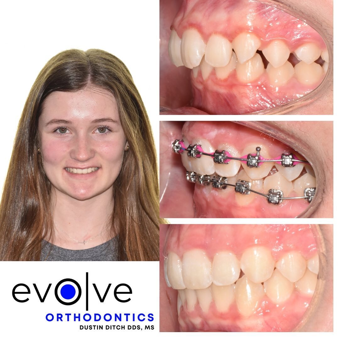 Ellie&rsquo;s amazing smile transformation was completed in only 20 months and look how beautiful her smile is! 

She came to us with:
🔹Deep overbite 
🔹Full step class II occlusion 
🔹Narrow arch forms 
🔹Upper and lower crowding 

Correcting a bit