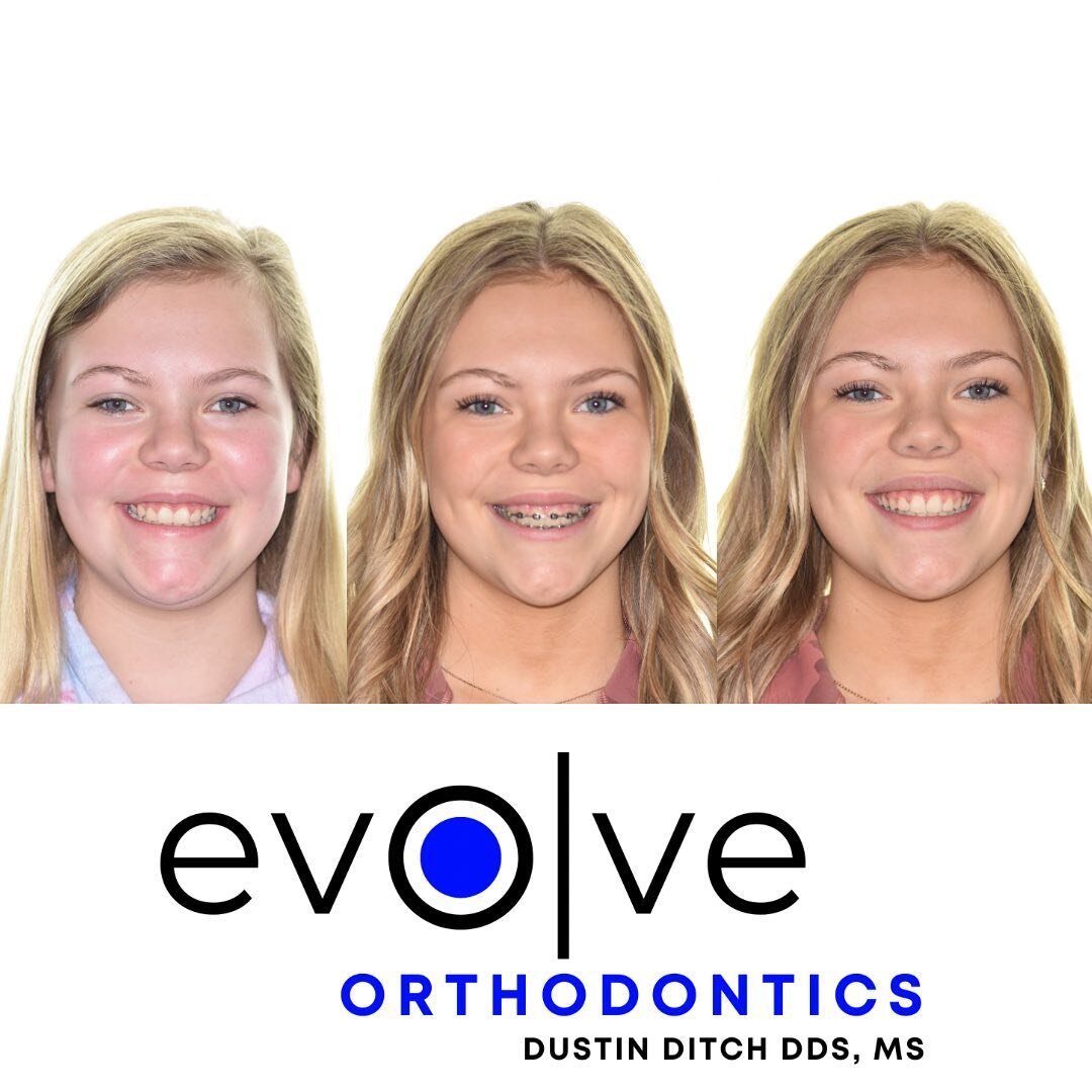 Izzy&rsquo;s amazing smile transformation was completed using #damonultima braces 

She came to us with:
🔹 Spacing between back teeth 
🔹Class II occlusion 
🔹Narrow arch forms 
🔹Crowding in anterior 

Izzy had her braces off in 13 months! Because 