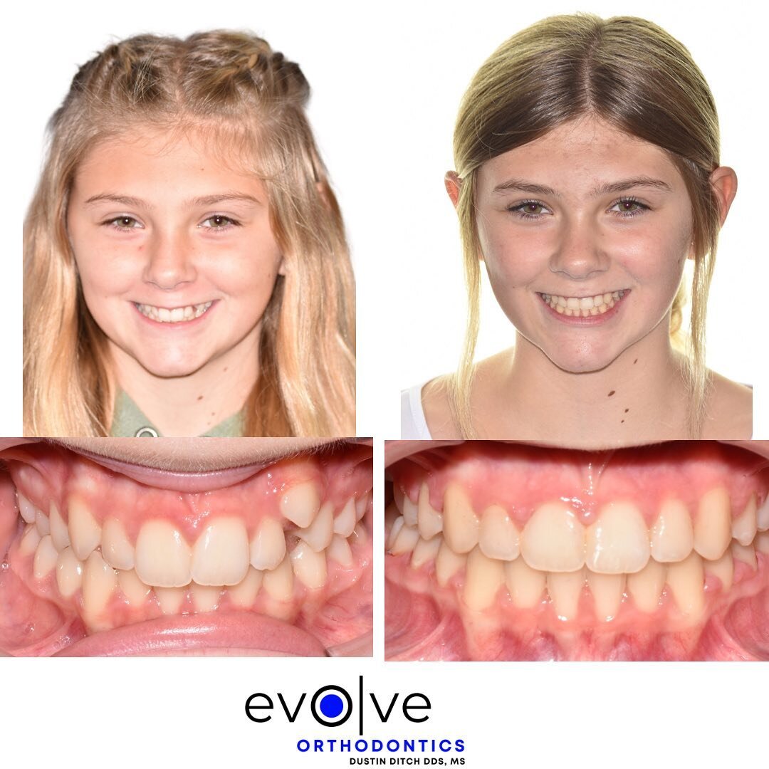 Jada&rsquo;s amazing smile transformation was completed using #damonultima braces and a distal jet expander 

She came to us with:
🔹 Blocked out upper canine 
🔹Unilateral class II occlusion 
🔹Narrow arch forms 
🔹Crowding 

Jada had her braces off