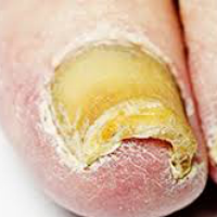Thick nails can be painful when wearing shoes.