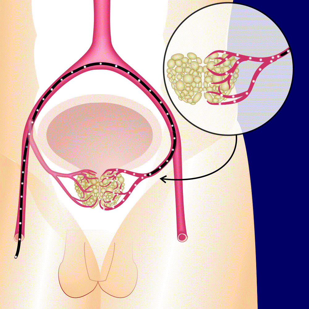 Fișier:Benign Prostatic Hyperplasia nci-voljpg - Wikipedia