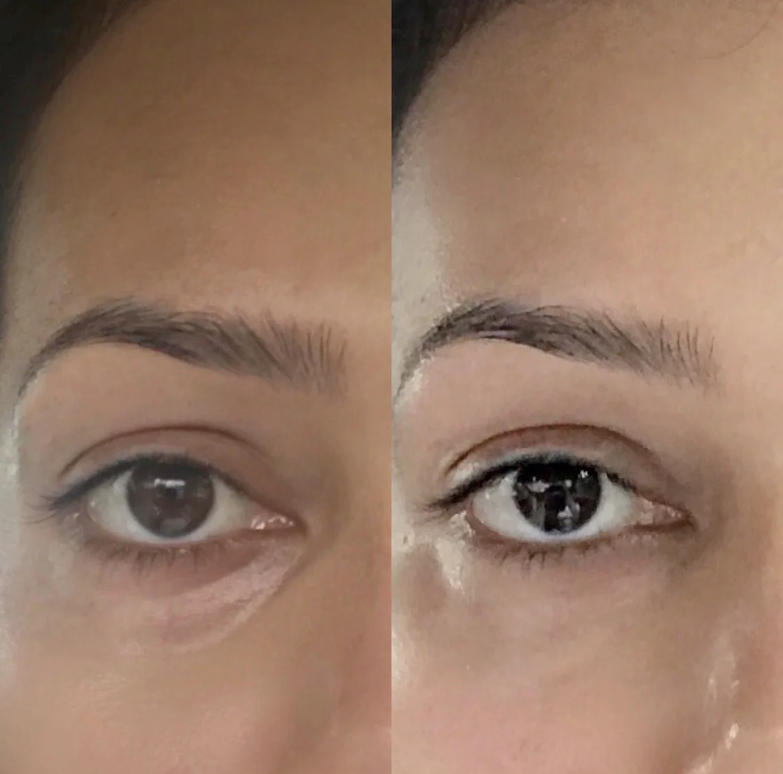 My Experience With Under Eye Dermal Fillers Life Of Jenna My Experience With Under Eye Dermal Fillers Life Of Jenna