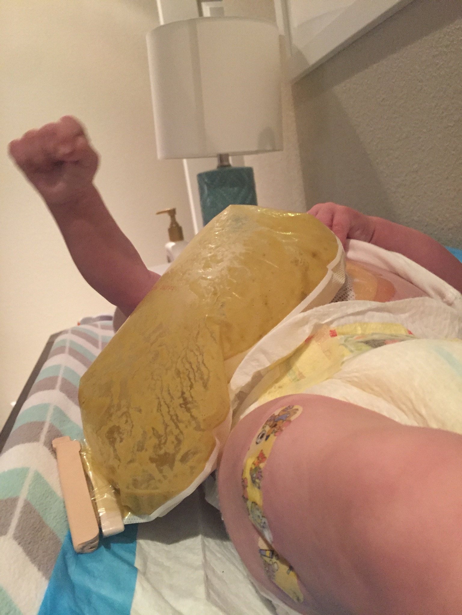 Ostomy — Our Life After NICU
