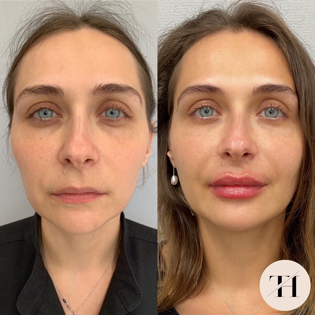 Hello summer refresh!

We did a touch up on the tear troughs and 1mL of Restylane Kysse on the lip. Photos taken immediately post treatment. 

Tracy Holzman NP-C
(@tracyholzmannp)

Amanda Muiter RN
(@amandaraenp)

Victoria Kartseva Master Aestheticia