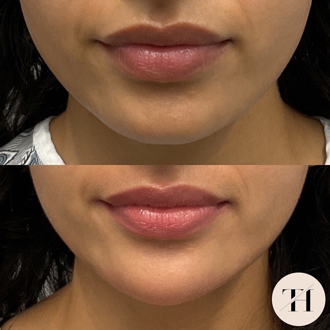 This patient recieved 1 syringe of RHA 4 in the chin to create a natural heart shaped face.

Tracy Holzman NP-C
(@tracyholzmannp)

Amanda Muiter RN
(@amandaraenp)

Victoria Kartseva Master Aesthetician
(@v_medesthetics)

Book with us!
+ Online at www