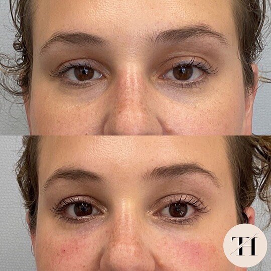 We used 1cc of Restylane-L on this beauty!
Photos were taken immediately after treatment. Redness will subside. 

Tracy Holzman NP-C
(@tracyholzmannp)

Amanda Muiter RN
(@amandaraenp)

Victoria Kartseva Master Aesthetician
(@v_medesthetics)

Book wit