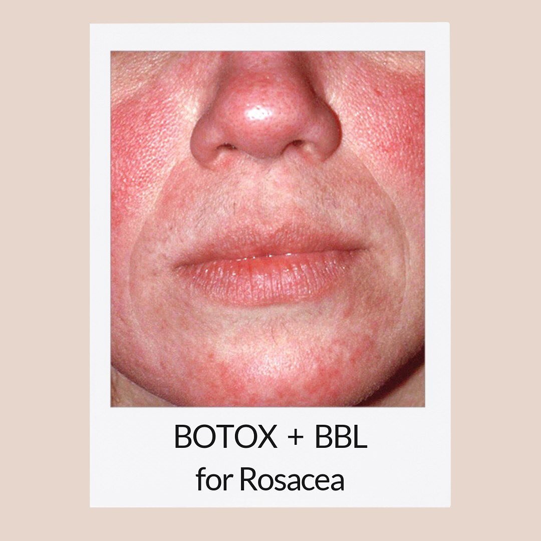 Rosacea (roe-ZAY-shuh) is a common skin condition that causes flushing and visible blood vessels in your face. It may also produce small, pus-filled bumps. There is currently no cure for this condition. Treatments generally revolve around reducing an