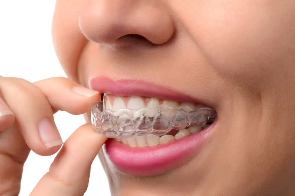 Clear Correct och Invisalign 