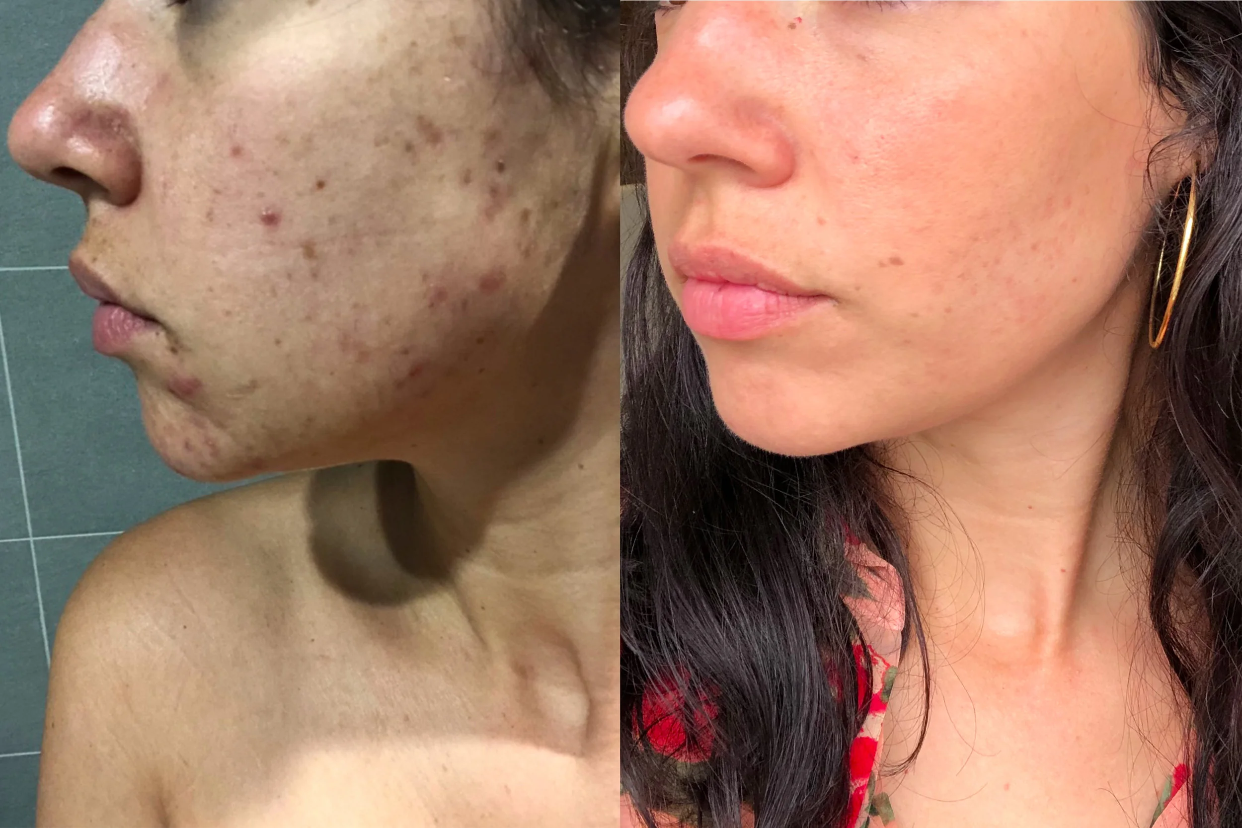 Healing Acne: a personal skin journey