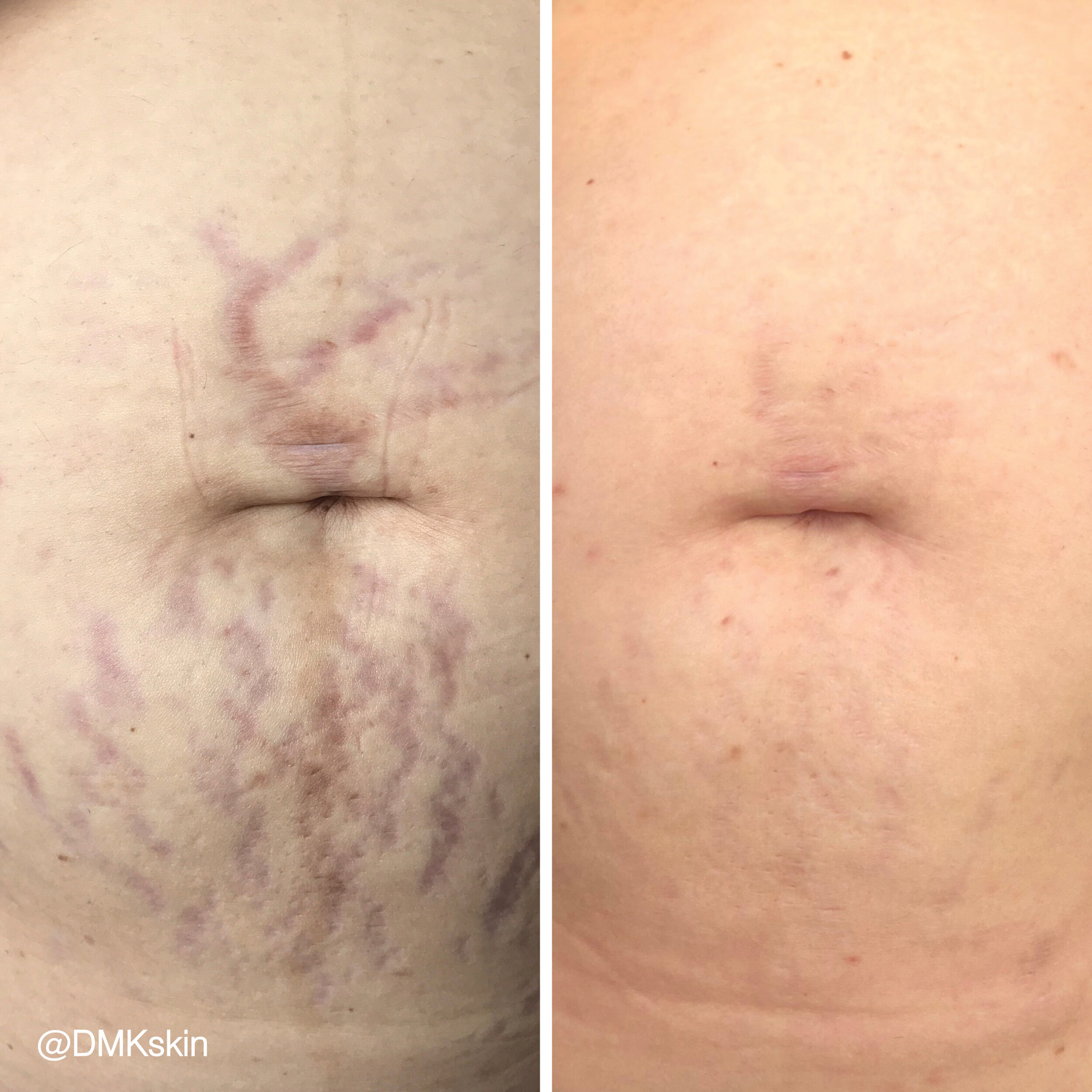 1440663599MyDMKBrandedBeforeandAfterImageryDMKskinLRScarring11.jpg