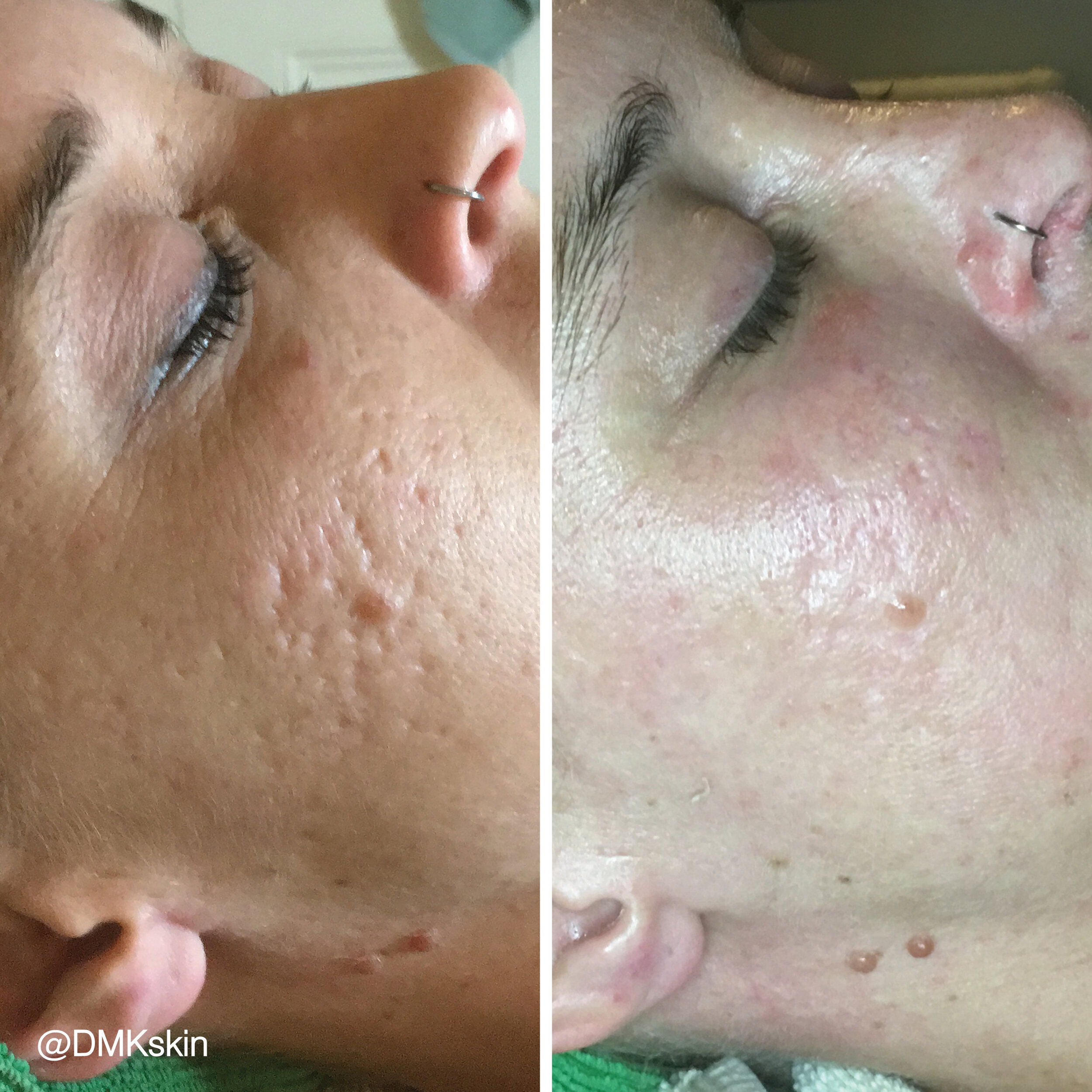 1726461325MyDMKBrandedBeforeandAfterImageryDMKskinLRScarring10.jpg