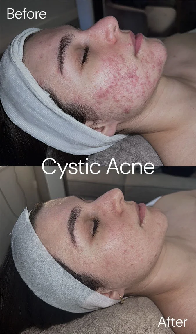 StSkin_Before-After_Cystic-Acne_Face.
