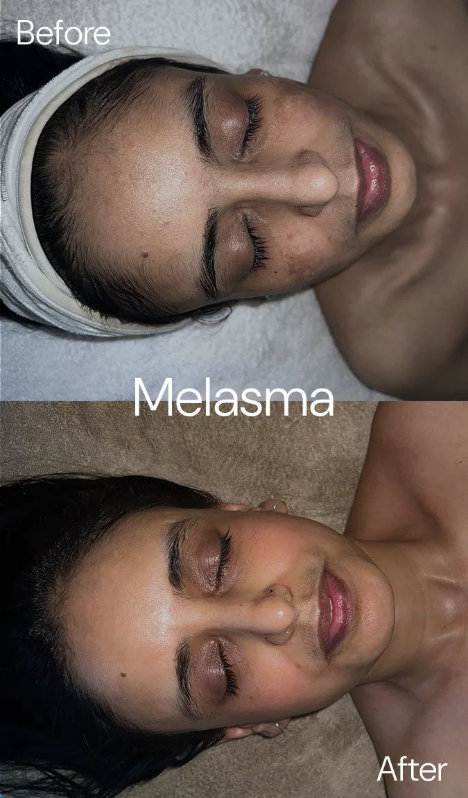 StSkin_Before-After_Melasma_Face.