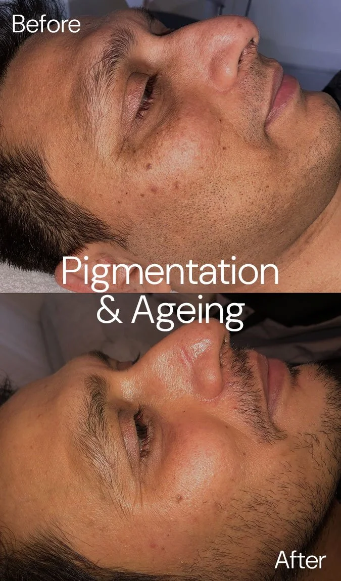 StSkin_Before-After_Pigmentation-Ageing_Face.jpg