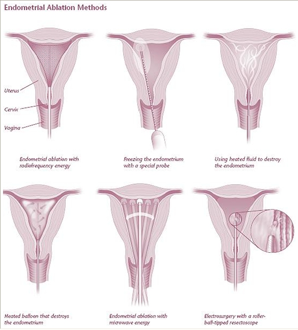 endometrium abláció novasure fogyás sírni lehet fogyni