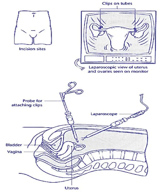sterilisation.jpg