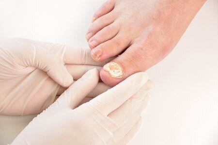 How effective is Tavaborole in treating toenail fungus? - Quora