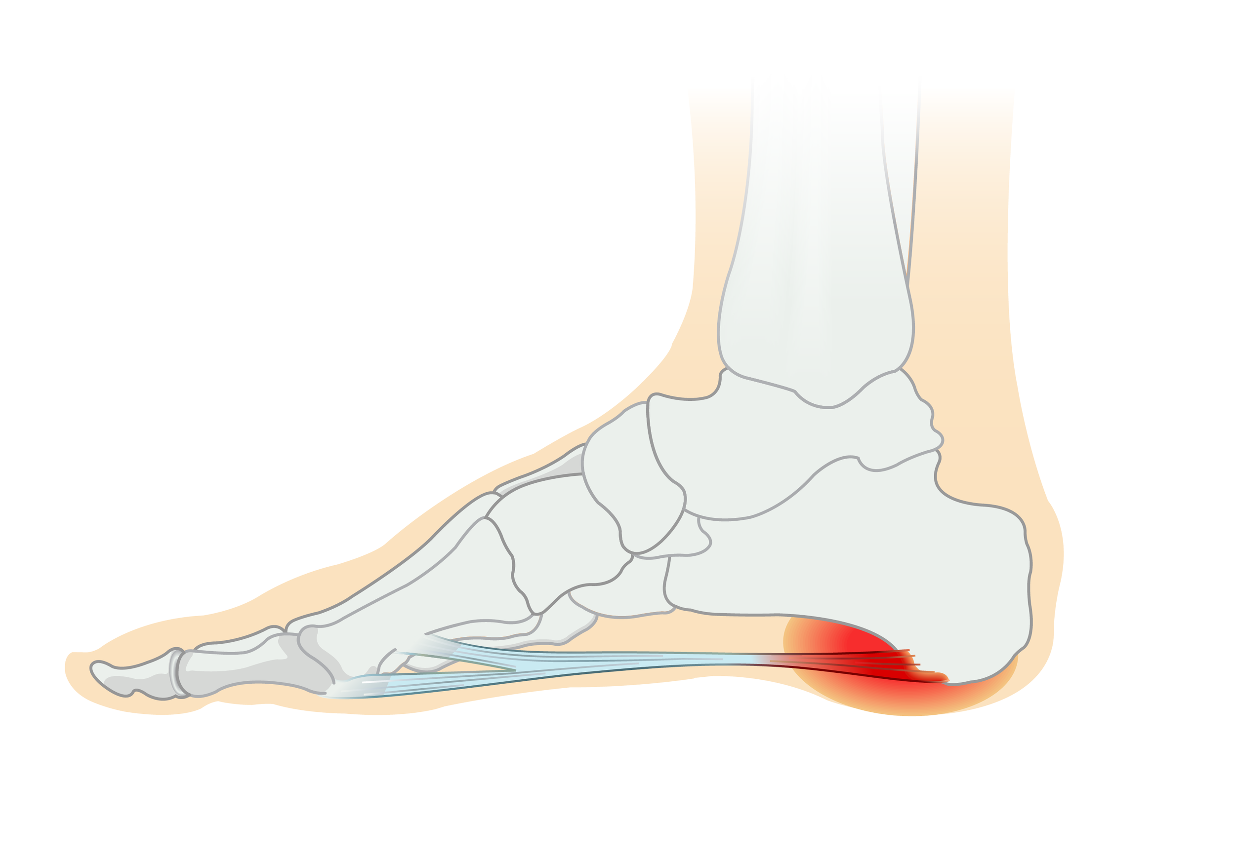 McRae_Heel-Spur_illus.png