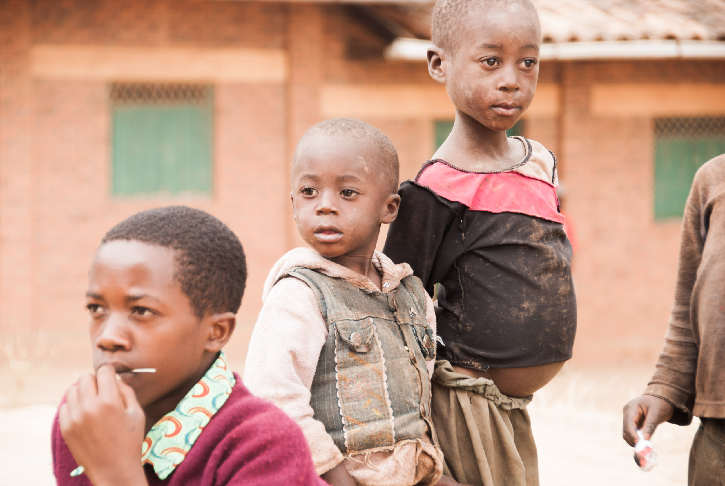  Kwashiorkor is a disease caused by severe dietary protein deficiency, and this girl in a village in the north showed one of its common symptoms: pot-belly. 