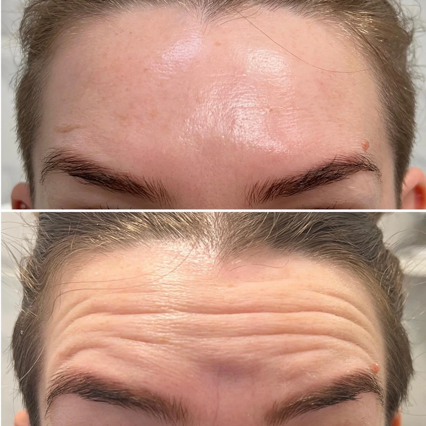 Best place for botox in Germantown TN 