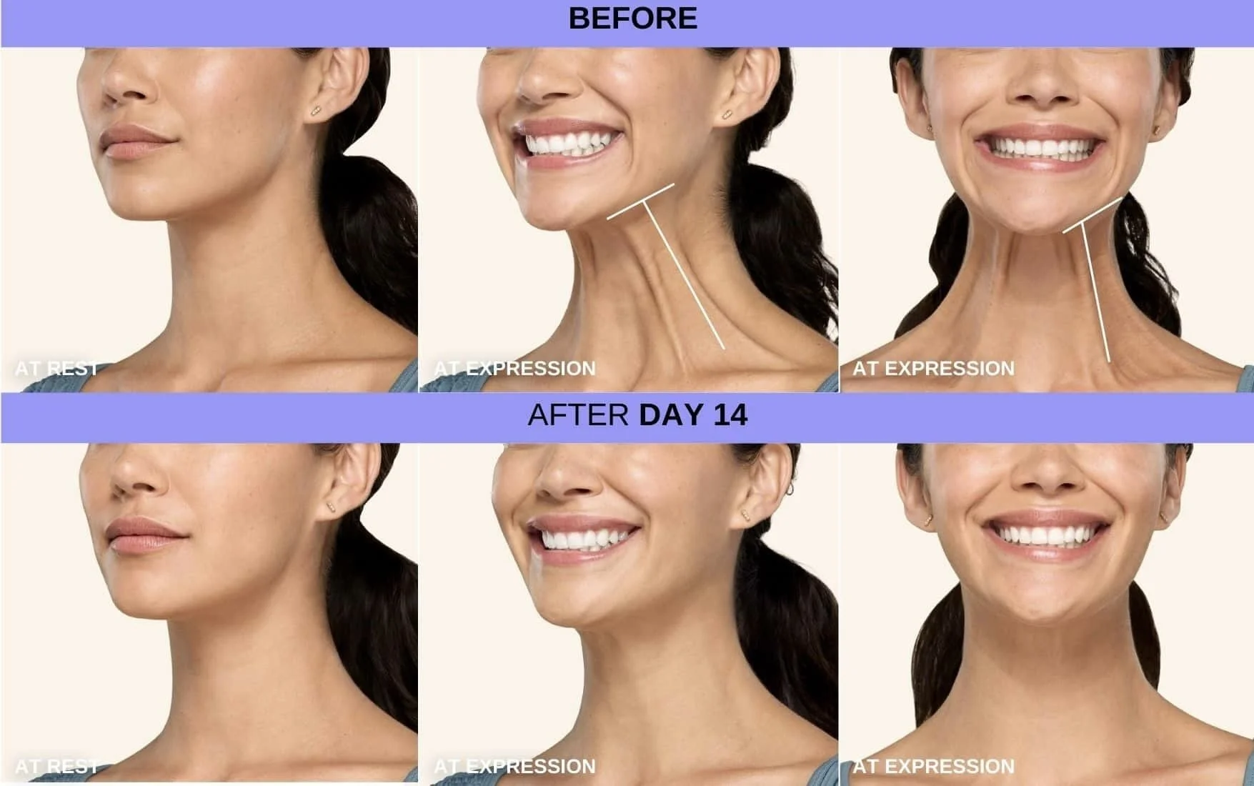 Botox for Platysmal Bands in Germantown, TN | Neck Botox at LaBella Skin Bar