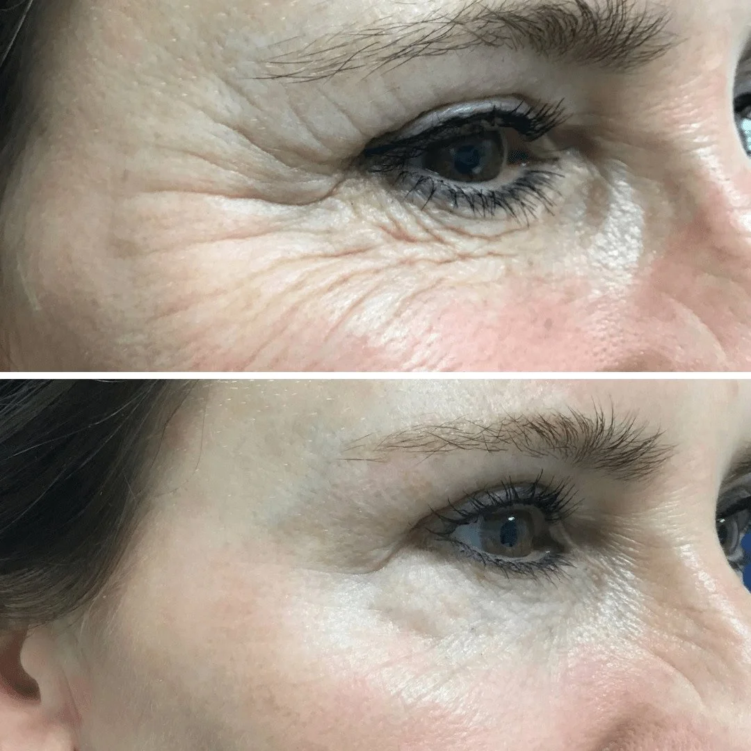 Everything You Need to Know About Plasmage Skin Tightening