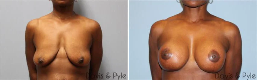 Breast Lift • With with 300cc Silicone Implants