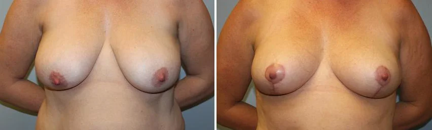 breast-reduction-before-after-raleigh-1.jpg