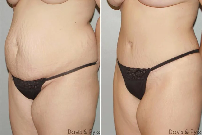 tummy-tuck-before-after-raleigh-1.jpg