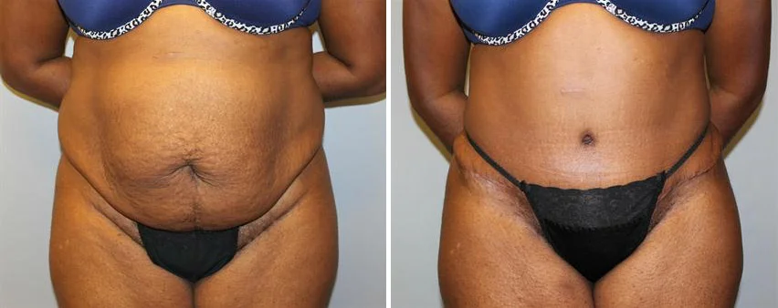 tummy-tuck-before-after-raleigh-3.jpg