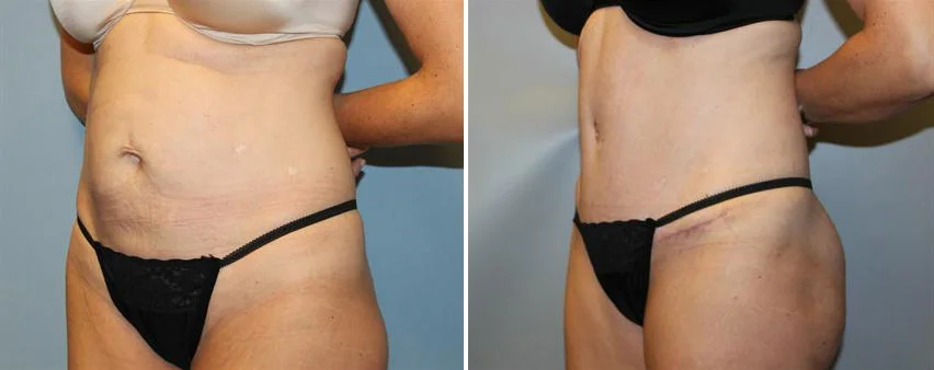 tummy-tuck-before-after-raleigh-4.jpg