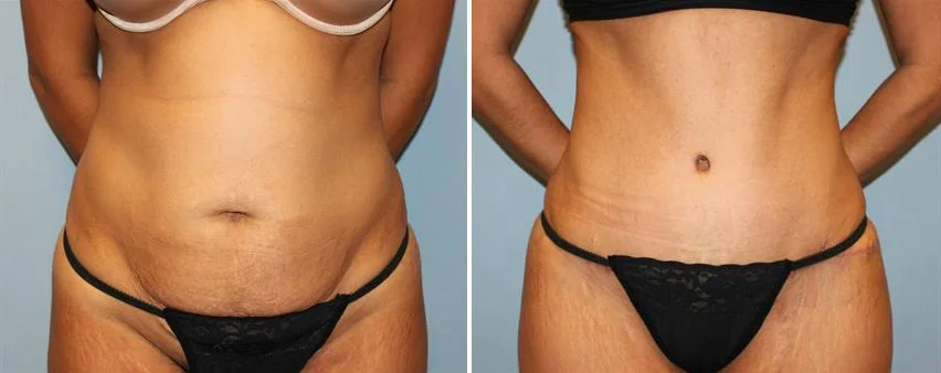 tummy-tuck-before-after-raleigh-5.jpg