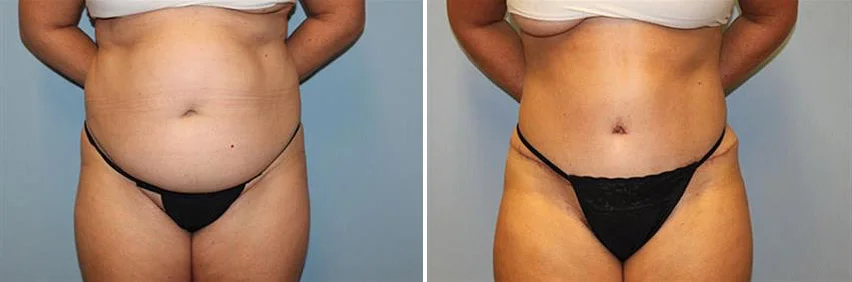tummy-tuck-before-after-raleigh-18.jpg