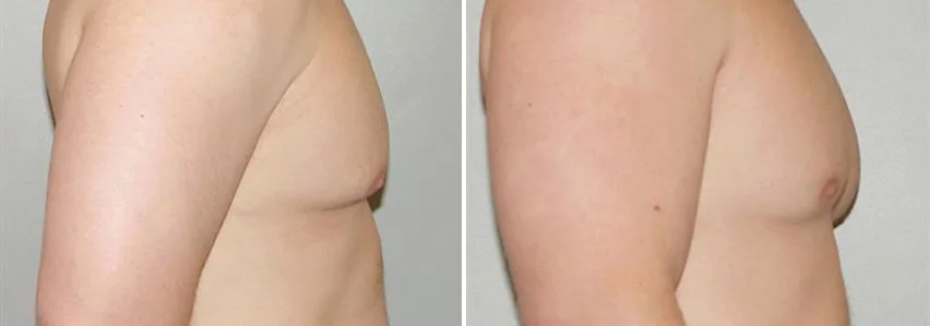 men-chest-fat-removal-gynecomastia-before-after-raleigh-3.jpg