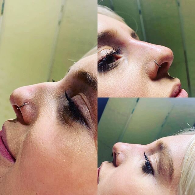 *Non surgical rhinoplasty*
.
.
.
Before to the left , after to the right 
Designed to give you the straight nose that you have always desired without going under the knife 😍💉 This is perfect for people who have that bump or dents 😃

Filller used: 