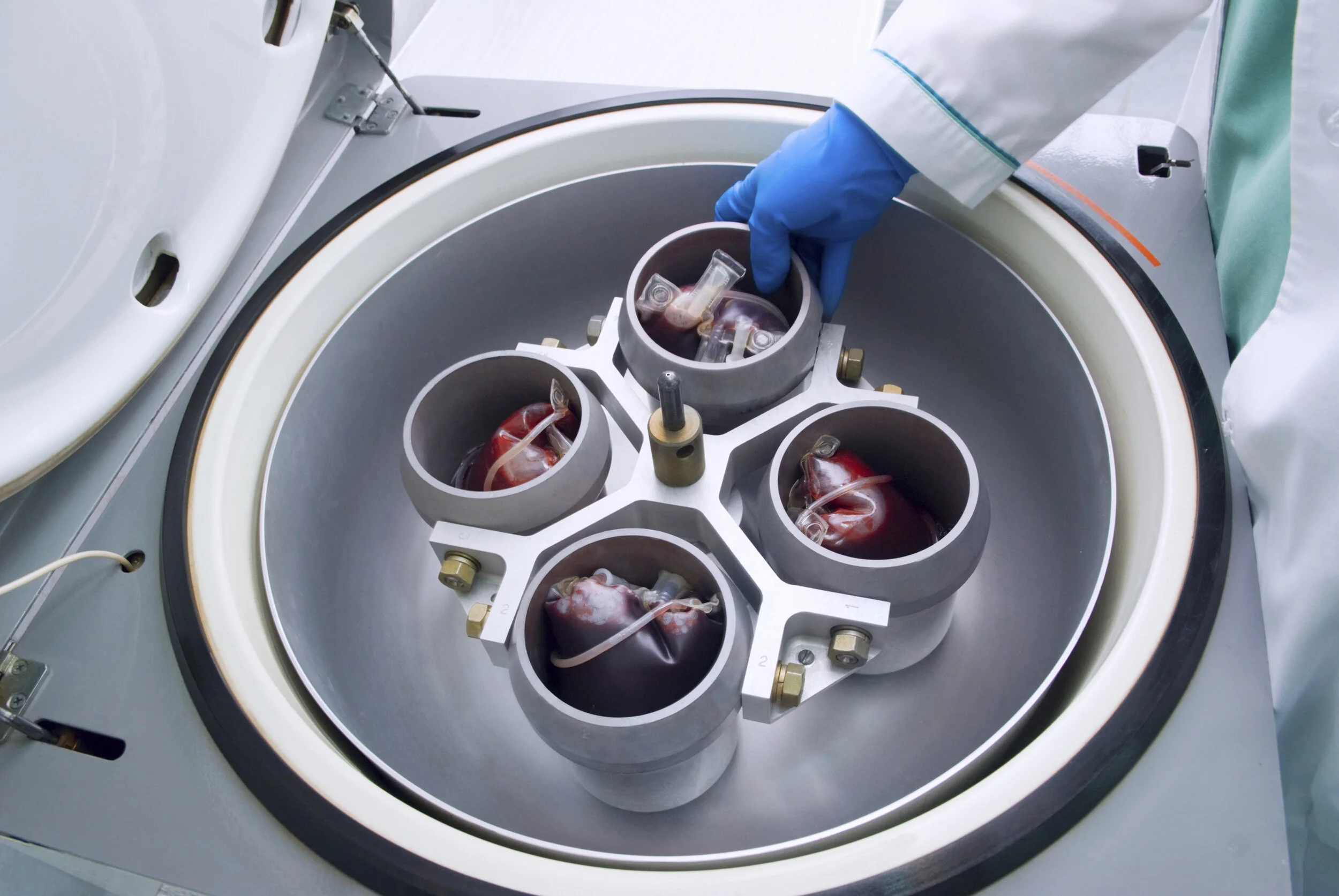 Plasmapheresis: Procedure Information &amp; Potential Complications