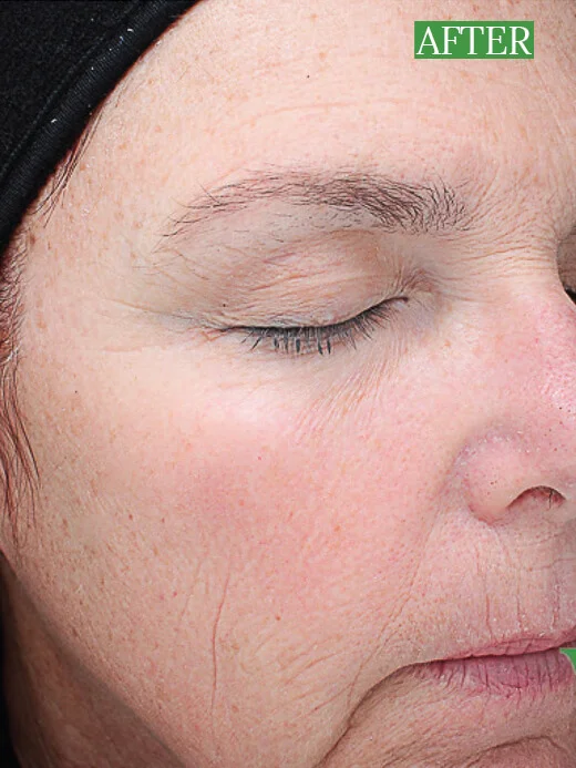 After 4 VI Peel with Precision Plus