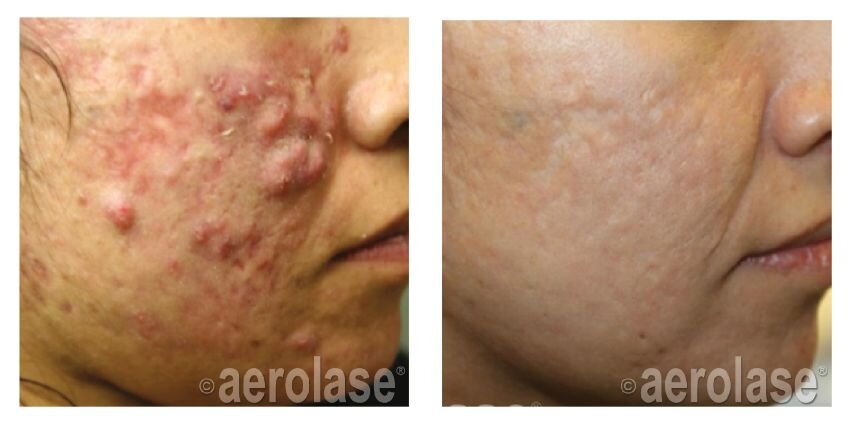 Can I do laser with active acne?