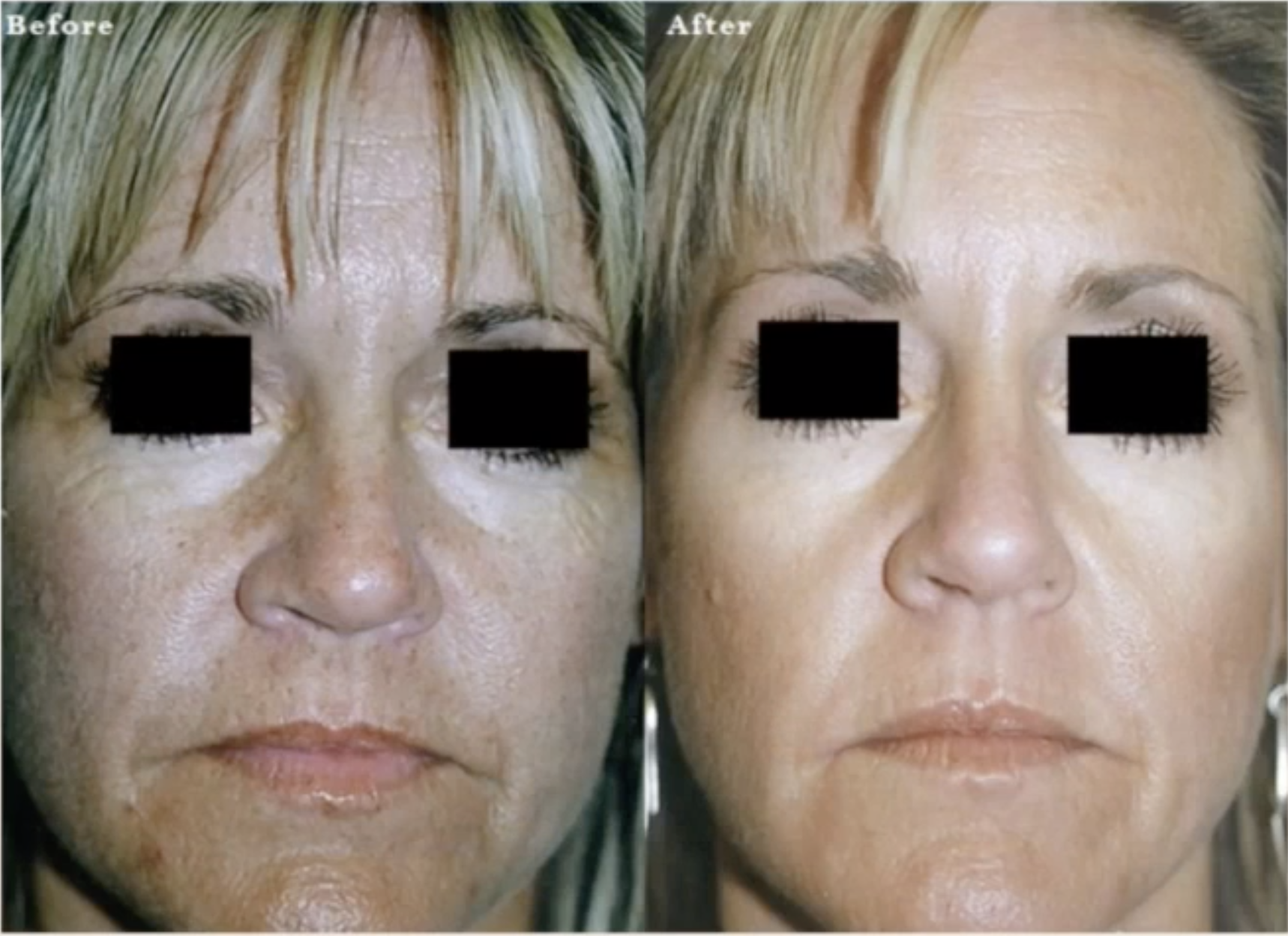 Before and after treatment with the Pheonix-15 CO2 Fractional Laser by Rohrer Aesthetics.