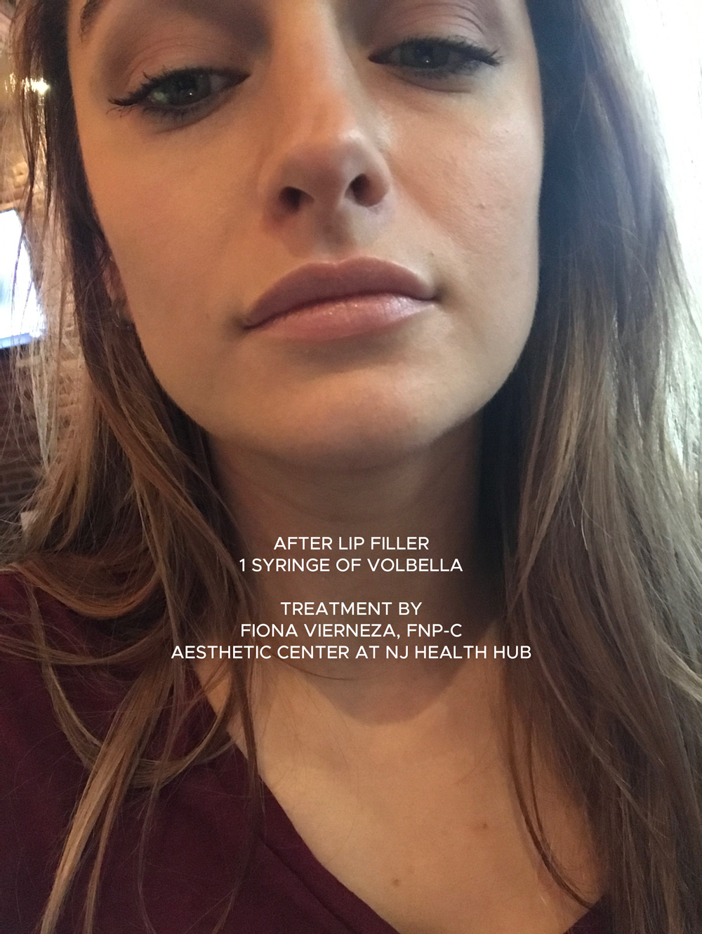 lip-filler-after-nj-health-hub-cedar-grove.png