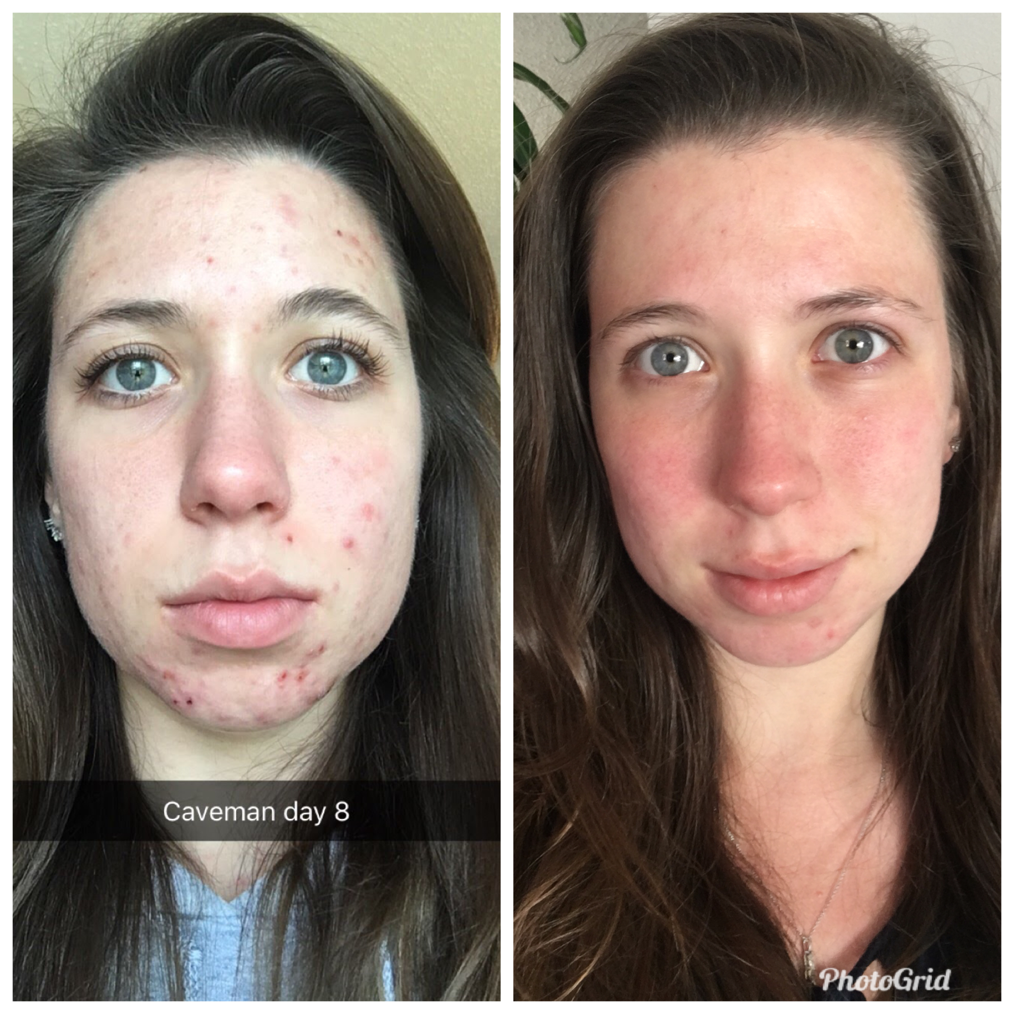 Left: February 2017; Right: May 2018 Both pictures are without makeup (I'm wearing only mascara in the left picture) to show a fair comparison!
