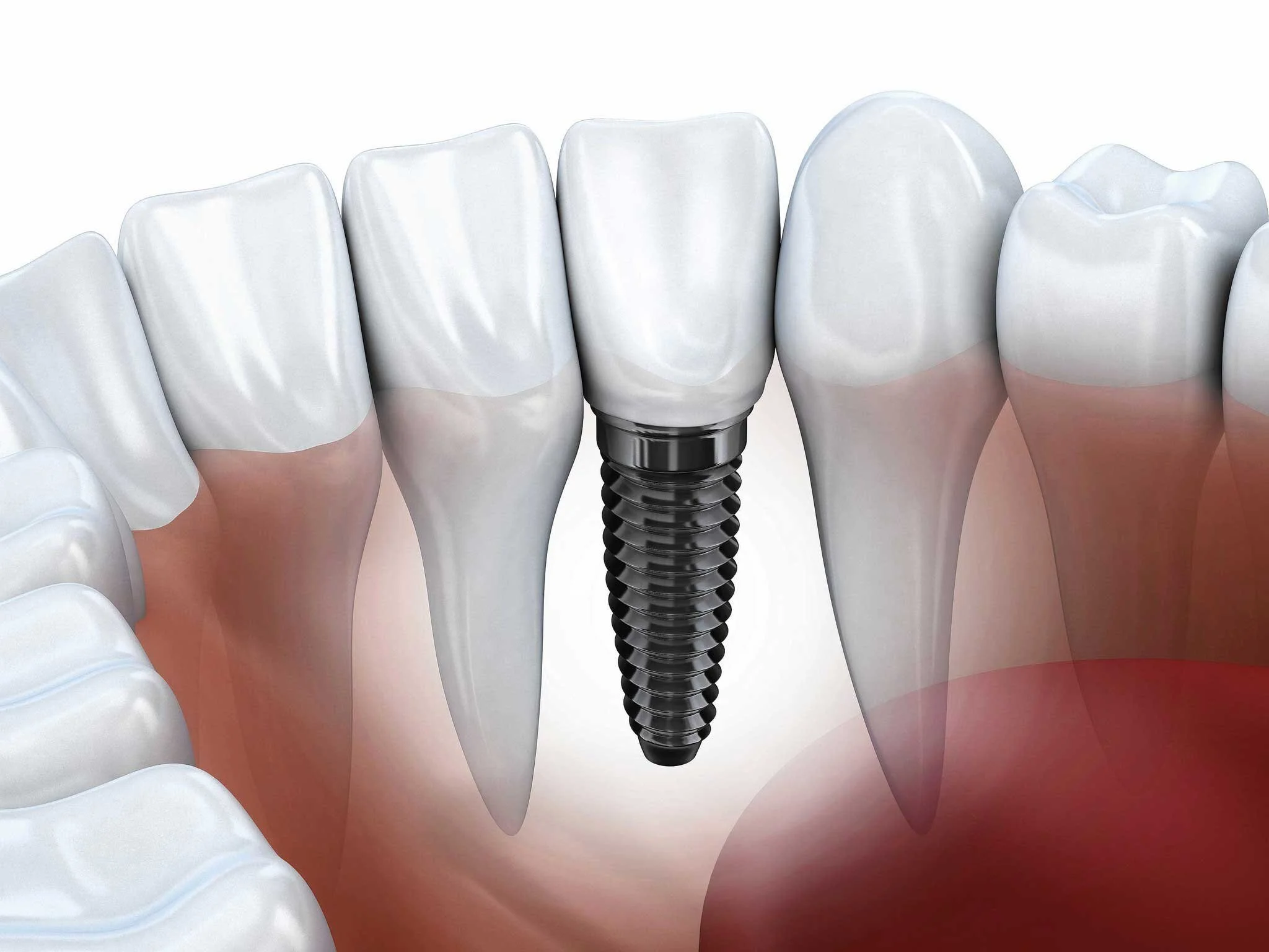 Dental-implants-1024x768@2x1.jpg